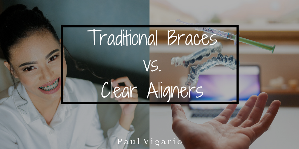 Traditional Braces v. Clear Aligners